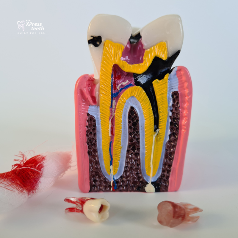 kdc root canal treatment home